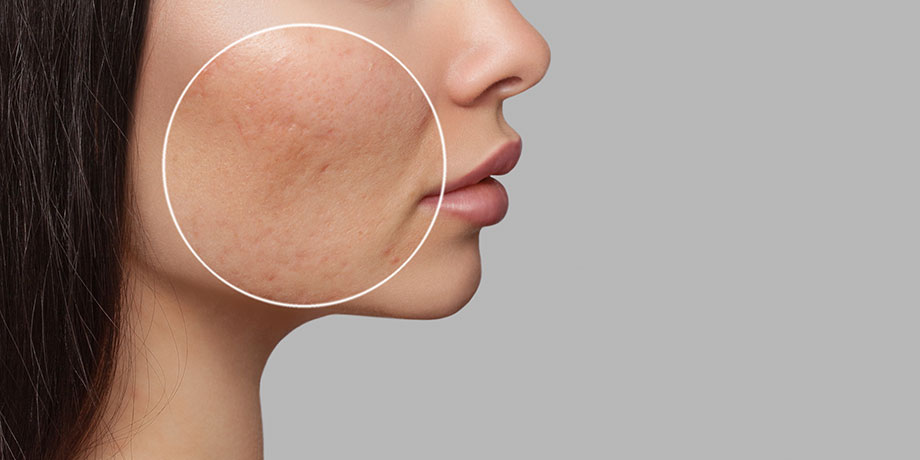 Acné / Pores dilatés / Excès de sebum